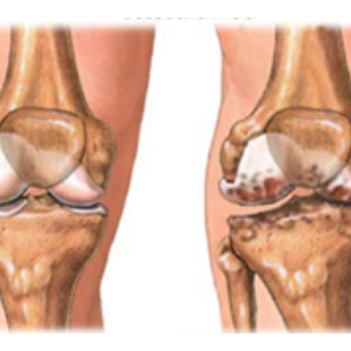 Prothèse totale du genou